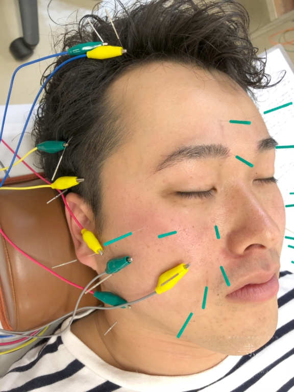 日本メディカル美容鍼協会認定・立体造顔美容鍼研修